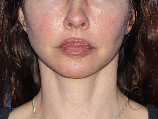 Neck Lift Before & After Gallery - Patient 149260196 - Image 6