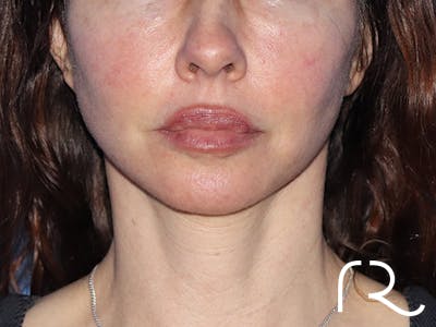 Neck Lift Before & After Gallery - Patient 149260196 - Image 6