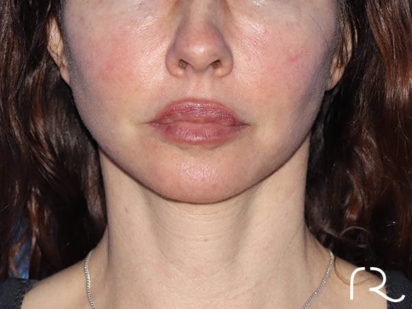 Neck Lift Before & After Gallery - Patient 149260196 - Image 6