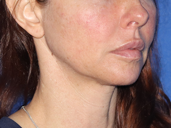 Neck Lift Before & After Gallery - Patient 149260196 - Image 1