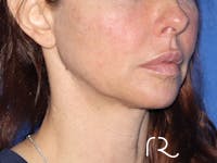 Neck Lift Before & After Gallery - Patient 149260196 - Image 1