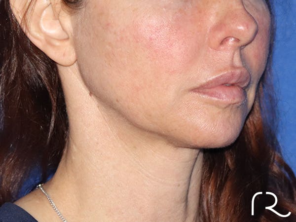 Neck Lift Before & After Gallery - Patient 149260196 - Image 1