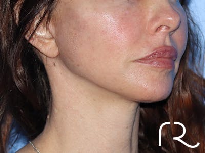 Facelift Before & After Gallery - Patient 149260195 - Image 6