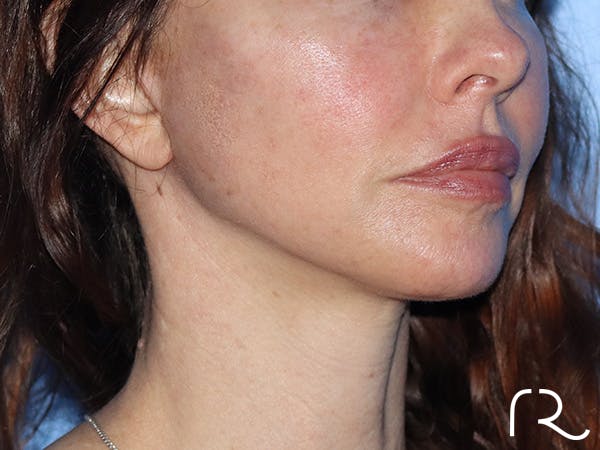 Neck Lift Before & After Gallery - Patient 149260196 - Image 2