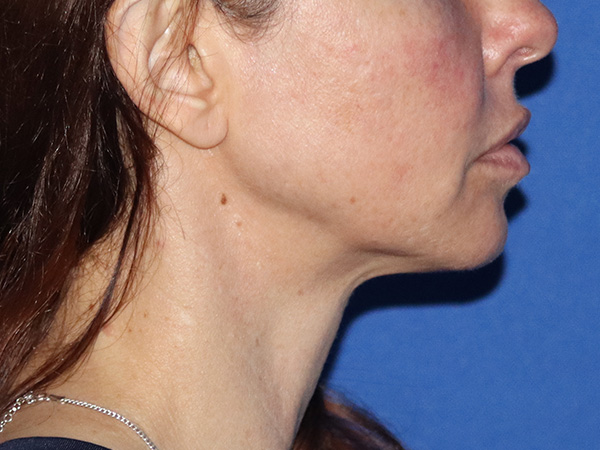 Neck Lift Before & After Gallery - Patient 149260196 - Image 3