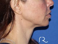 Facelift Before & After Gallery - Patient 149260195 - Image 1