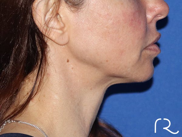 Neck Lift Before & After Gallery - Patient 149260196 - Image 3