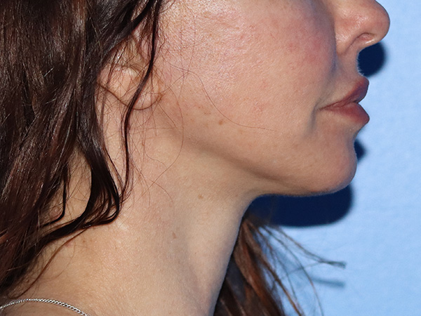 Neck Lift Before & After Gallery - Patient 149260196 - Image 4