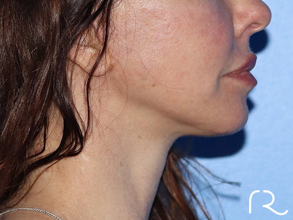 Neck Lift Before & After Gallery - Patient 149260196 - Image 4