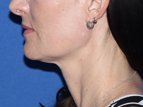 Neck Lift Before & After Gallery - Patient 149260201 - Image 1