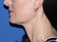Facelift Before & After Gallery - Patient 149260202 - Image 1