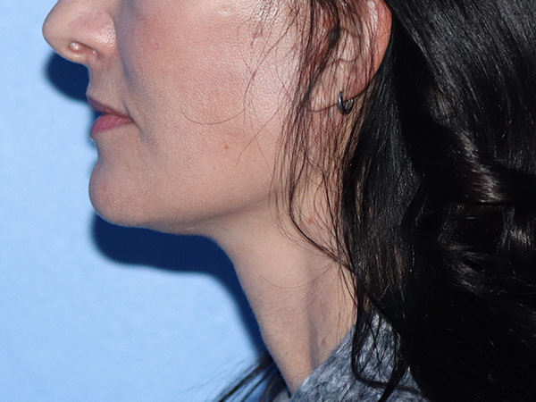 Facelift Before & After Gallery - Patient 149260202 - Image 2