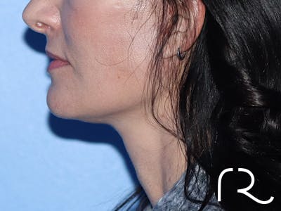 Facelift Before & After Gallery - Patient 149260202 - Image 2