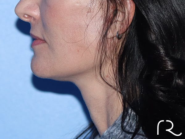 Facelift Before & After Gallery - Patient 149260202 - Image 2