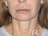 Facelift Before & After Gallery - Patient 149260203 - Image 1