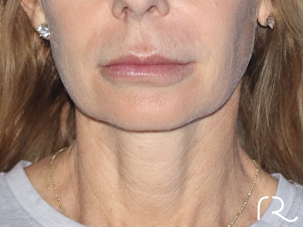 Facelift Before & After Gallery - Patient 149260203 - Image 1