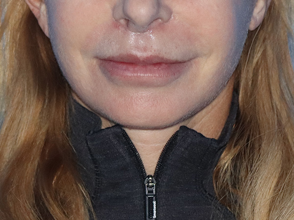 Neck Lift Before & After Gallery - Patient 149260204 - Image 2