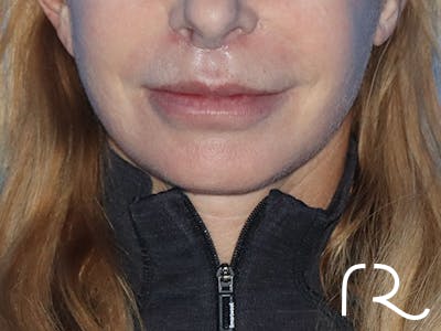Facelift Before & After Gallery - Patient 149260203 - Image 2