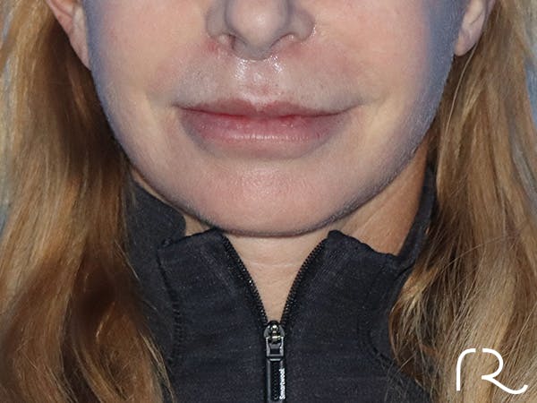 Facelift Before & After Gallery - Patient 149260203 - Image 2