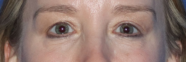 Eyelid Surgery Before & After Gallery - Patient 161308430 - Image 1
