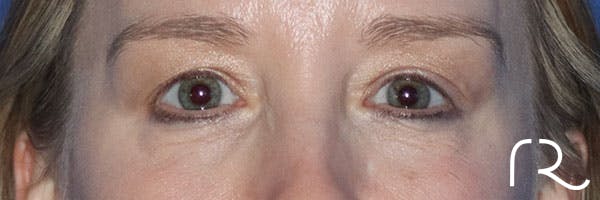 Eyelid Surgery Before & After Gallery - Patient 161308430 - Image 1