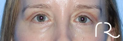 Eyelid Surgery Before & After Gallery - Patient 161308430 - Image 2
