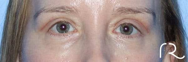 Eyelid Surgery Before & After Gallery - Patient 161308430 - Image 2