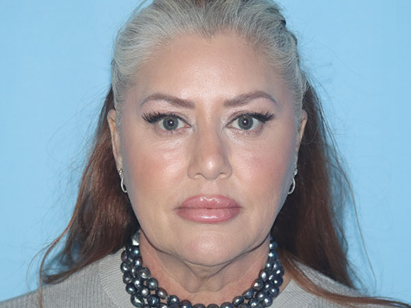 R2 Extended Deep Neck Lift Before & After Gallery - Patient 161309093 - Image 3