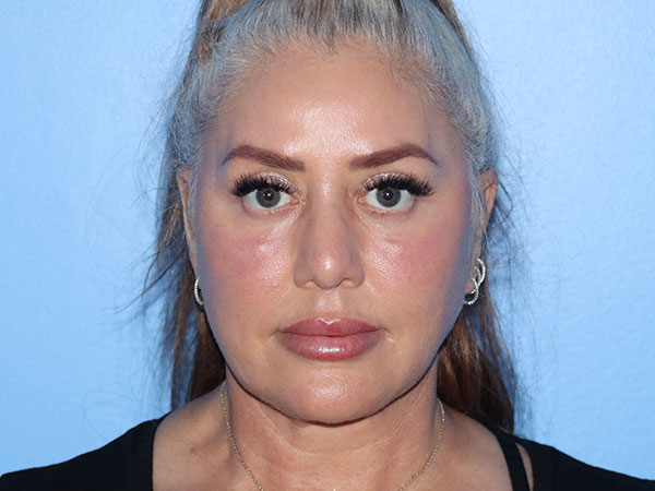 R2 Extended Deep Neck Lift Before & After Gallery - Patient 161309093 - Image 4