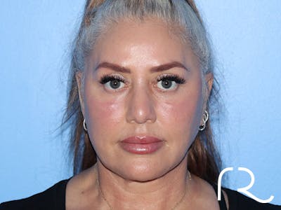 Facelift Before & After Gallery - Patient 161309089 - Image 4