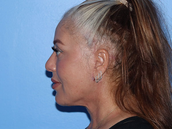 R2 Extended Deep Neck Lift Before & After Gallery - Patient 161309093 - Image 6