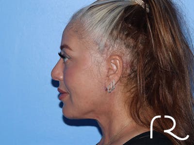Extended Deep Neck Lift Before & After Gallery - Patient 161309093 - Image 6