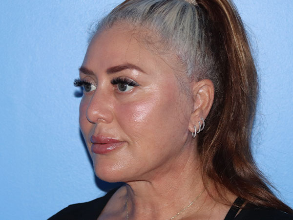 R2 Extended Deep Neck Lift Before & After Gallery - Patient 161309093 - Image 2