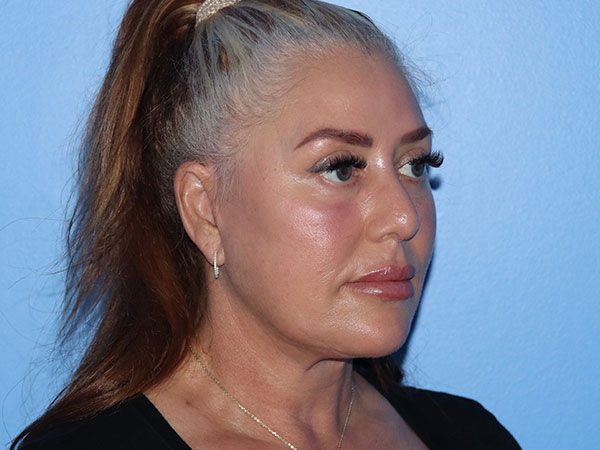 R2 Extended Deep Neck Lift Before & After Gallery - Patient 161309093 - Image 8