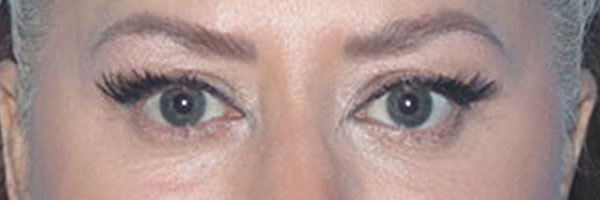 Eyelid Surgery Before & After Gallery - Patient 161309076 - Image 1