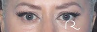Eyelid Surgery Before & After Gallery - Patient 161309076 - Image 1