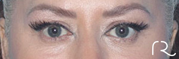 Eyelid Surgery Before & After Gallery - Patient 161309076 - Image 1