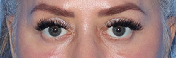 Eyelid Surgery Before & After Gallery - Patient 161309076 - Image 2