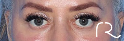 Eyelid Surgery Before & After Gallery - Patient 161309076 - Image 2