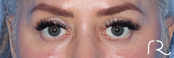 Eyelid Surgery Before & After Gallery - Patient 161309076 - Image 2
