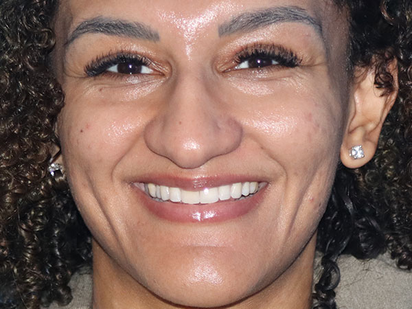 Rhinoplasty Before & After Gallery - Patient 161308513 - Image 5