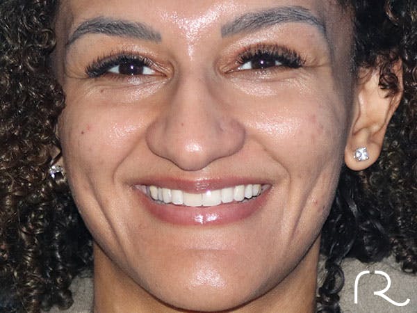 Rhinoplasty Before & After Gallery - Patient 161308513 - Image 5