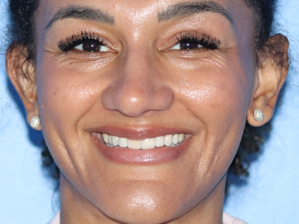 Rhinoplasty Before & After Gallery - Patient 161308513 - Image 6