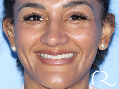 Rhinoplasty Before & After Gallery - Patient 161308513 - Image 6