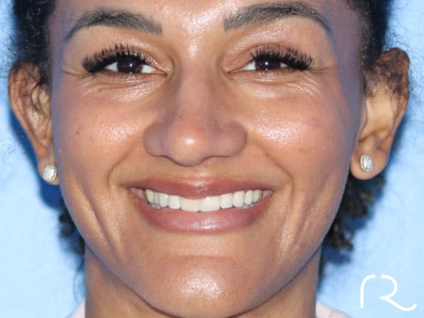 Rhinoplasty Before & After Gallery - Patient 161308513 - Image 6