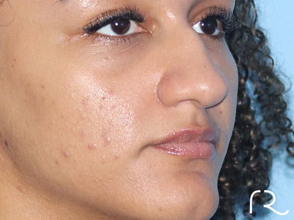 Rhinoplasty Before & After Gallery - Patient 161308513 - Image 1