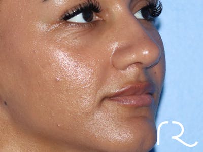 Rhinoplasty Before & After Gallery - Patient 161308513 - Image 2