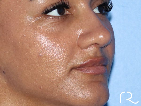 Rhinoplasty Before & After Gallery - Patient 161308513 - Image 2