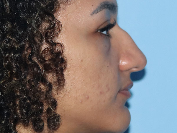 Rhinoplasty Before & After Gallery - Patient 161308513 - Image 3