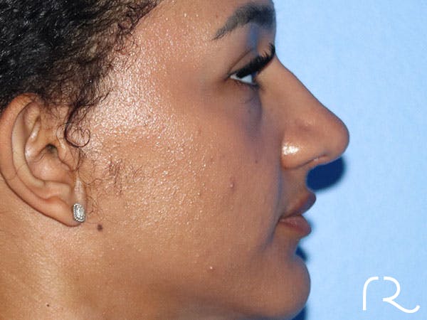 Rhinoplasty Before & After Gallery - Patient 161308513 - Image 4